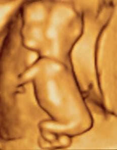 Fetal ultrasound scan image